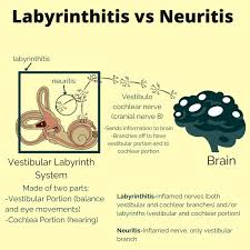 Image result for Bacterial Labyrinthitis