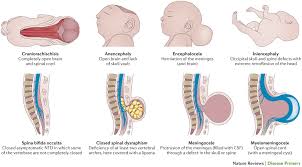 Spina Bifida Types Medical Ultrasound Diagnostic Medical Sonography Nursing Notes