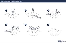 Schon bei abnahme des bh's habe ich höllische schmerzen. Schlupfwarzen Was Hilft Gegen Hohlwarzen Info Medizin