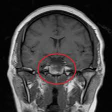 Image result for Galactorrhea