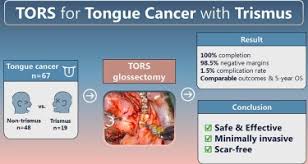 Image result for Trismus