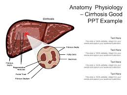 Cirrhosis may be caused by a buildup of fat in the liver of people who are overweight or have diabetes. 36289835 Style Medical 2 Immune 2 Piece Powerpoint Presentation Diagram Infographic Slide Powerpoint Slide Templates Download Ppt Background Template Presentation Slides Images