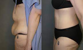The table below provides a general outline of potential cost factors. Tummy Tuck New Jersey Bergen County Englewood Dr David Abramson