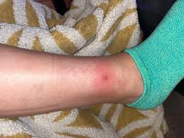 Image result for spinne biss haut reaktion