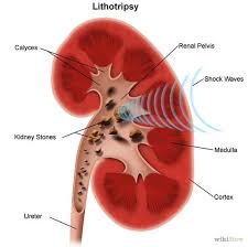How To Prevent Kidney Stones From Recurring Treat Kidney Stones Kidney Stones Kidney Stones Remedy