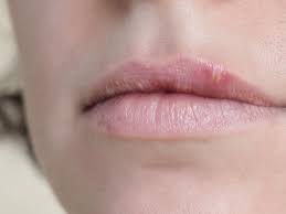 Lippenherpes Symptome Diagnose Und Behandlung Fernarzt