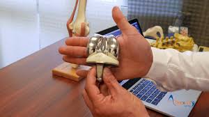 Quand toutes les solutions thérapeutiques ont été épuisées, la pose d'une prothèse la pose d'une prothèse du genou est une intervention qui nécessite une semaine d'hospitalisation. Prothese De Genou A La Clinique Chantecler Groupe Almaviva Sante Youtube