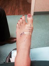 Pin On Bunion Surgery And Other Facts Advice
