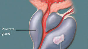 When cancer is confined to the prostate, many men have no symptoms. Live Chennai Do You Know These Signs Of Prostate Cancer Signs Of Prostate Cancer