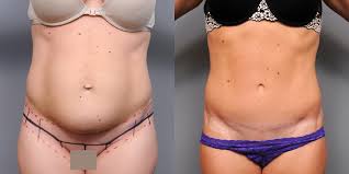 You should always remember that tattoo is made for the whole rest of your life and its meaning will be always fallowing you. How To Keep Your Tummy Tuck A Secret Even At The Beach Plastic Surgery News For New York City From Dr Thomas P Sterry