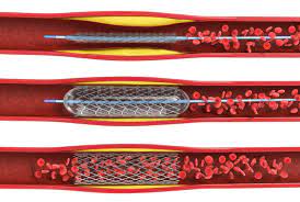 Patienten Behandlungsmoeglichkeiten Stent Abiomed De