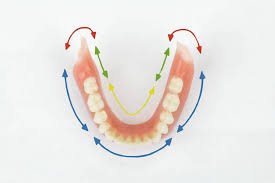 Glues may contain toxins that may seep into the gums, and the toxins are not healthy for the denture wearer. What Are Suction Dentures Hayven Dentures St Catharines