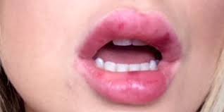 Maybe you would like to learn more about one of these? What It Really Feels Like To Have Lip Fillers