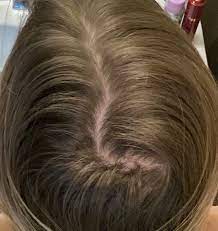 Muscle loss, weight loss, osteoporosis, and depression — even menopause. Elevated Dheas With Hair Shedding What Might Be Going On Donovan Hair Clinic