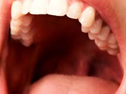 Image result for Oral thrush roof of mouth