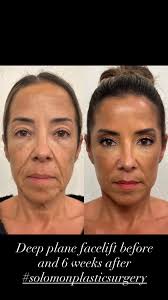 #deeplanefacelift #facelift #faceliftbeforeandafter #facialrejuvunation  #naturalfacelift #solomonplasticsurgery #cosmeticsurgery  #tripleboardcertified #classicplastic #friscotx
