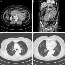 I've seen like 2 minutes. Computed Tomography Ct Scan Results A B Abdominal Ct Scan Showing Download Scientific Diagram