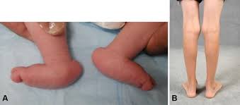 Noonan definition clubfoot, also known as congenital talipes equinovarus, occurs in approximately 1 in 1000 live births. The 2017 Abjs Nicolas Andry Award Advancing Personalized Medicine For Clubfoot Through Translational Research Springerlink