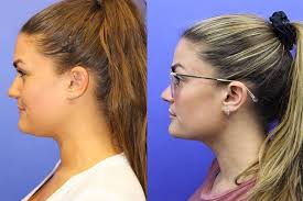 Here S How Brittany Cartwright Completely Transformed Her Chin Without Surgery Double Chin Surgery Neck Liposuction Double Chin