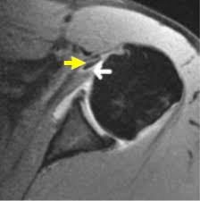 The different bursae of the hip region (trochanteric, ischial and iliopectineal bursae) Treatment Of Isolated Subscapularis Tears Cancer Therapy Advisor