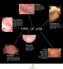 How To Recognize What Kind Of Acne You Have Innate Skin Types Of Acne Skin Treatments Skin Care Acne