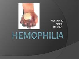 It is probable that the royal hemophilia appeared because of a spontaneous mutation in queen victoria. Ppt Hemophilia Powerpoint Presentation Free Download Id 2121812