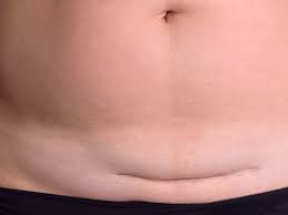 6 Ways To Get Rid Of That Belly After A C Section Belly Pooch C Section Belly C Section Workout