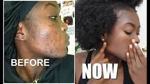 You can wash your hair like once week and make sure you condition it well, sit with in your hair with a cap on it for a little while. Skincare 101 How To Get Rid Of Dark Spots Essence