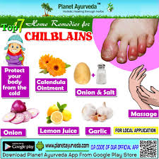 Chilblain Occurs Because Of Sudden Warming Of The Skin After Being Exposed To Cold Temperatures For A L Ayurveda Herbal Herbal Remedies Natural Supplements