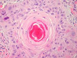 Variable degrees of keratinization, sometimes squamous eddies or keratin pearls; Squamous Cell Carcinoma Pathology Dermnet Nz