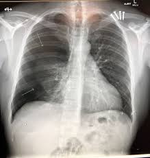Often, someone who has a collapsed lung gets another within 1 or 2 years. The Lungs Queensland Health