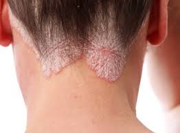 A gravidade é variável, desde manchas pequenas e localizadas até ao revestimento total do corpo. Brasil E O 2Âº No Ranking Do Impacto Da Psoriase Na Qualidade De Vida Diga Bahia