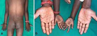 Image result for Diffuse Hyperpigmentation