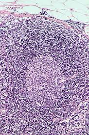 Follicular Hyperplasia Wikipedia