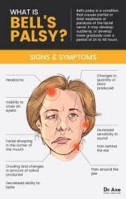 Is Bell S Palsy From Lyme Disease Or Something Else Bell S Palsy Symptoms Natural Treatments Signs Symptoms