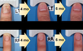 I have only experienced the usual side effects such as; Psoriasis Treatment Phototherapy