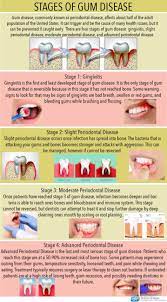 Bleeding Gums Philadelphia Pa | Gum Disease | Gingivitis