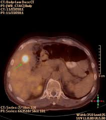 Certified medical professionals are ready to answer your cancer questions. Diagnostic Modalities In Colorectal Cancer Endoscopy Ct And Pet Scanning Magnetic Resonance Imaging Mri Endoluminal Ultrasound And Intraoperative Ultrasound Intechopen