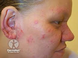 Image result for Photodermatitis