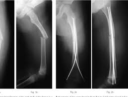 Get humerus nail at best price from humerus nail retailers, sellers, traders, exporters & wholesalers listed at exportersindia.com. Pdf Aspects Of Current Management Flexible Intramedullary Nails For Fractures In Children Semantic Scholar