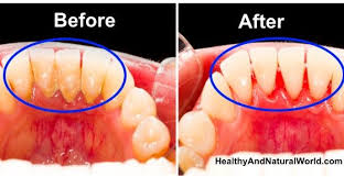 If it's ready, the tooth should come right out. 5 Mixtures That Completely Remove Plaque From Your Teeth Plaque Removal At Home Remove Plaque Plaque Removal