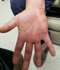 Image result for Erythema Multiforme