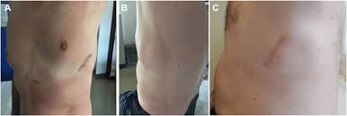 More advanced devices (icd, implantable cardioverter defibrillator; Complete Healing Of The Wound At Follow Up Patient 12 A And B And Download Scientific Diagram