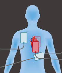 Defibrillation, and the circumstances & conditions leading up to defibrillation, are in some ways realistically depicted in popular culture but are in other ways rather different. To Perform Dual Shock Defibrillation Place One Set Of Defibrillator Pads In The Traditional Positions On