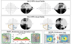 Image result for Visual Field Deficit
