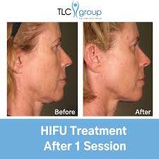 Wow This Client Achieved Amazing Results After Just One Hifu Session We Have The Best Hifu Device On The Marke Laser Clinics Clinic Unwanted Hair Removal