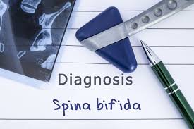 Spina bifida can happen anywhere along the spine if the neural tube does not close all the way. Spina Bifida Cause Sintomi E Cura Ohga