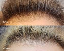Hair growth ingredients 3:16 how to apply the ordinary multi peptide serum for hair density 5:21 how to use when you this gives me a small commission to continue to purchase new products to review for you all on this channel. Three Month Results The Ordinary Multi Peptide Serum For Hair Density Raiyne On Beauty