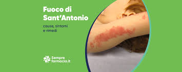 Fuoco di SantAntonio: cause, sintomi e rimedi | Semprefarmacia