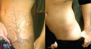 Let us help you find a tattoo vanish technician in illinois. The Profitable Economics Of The Tattoo Removal Industry